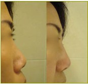 微晶瓷玻尿酸隆鼻效果前后對(duì)比